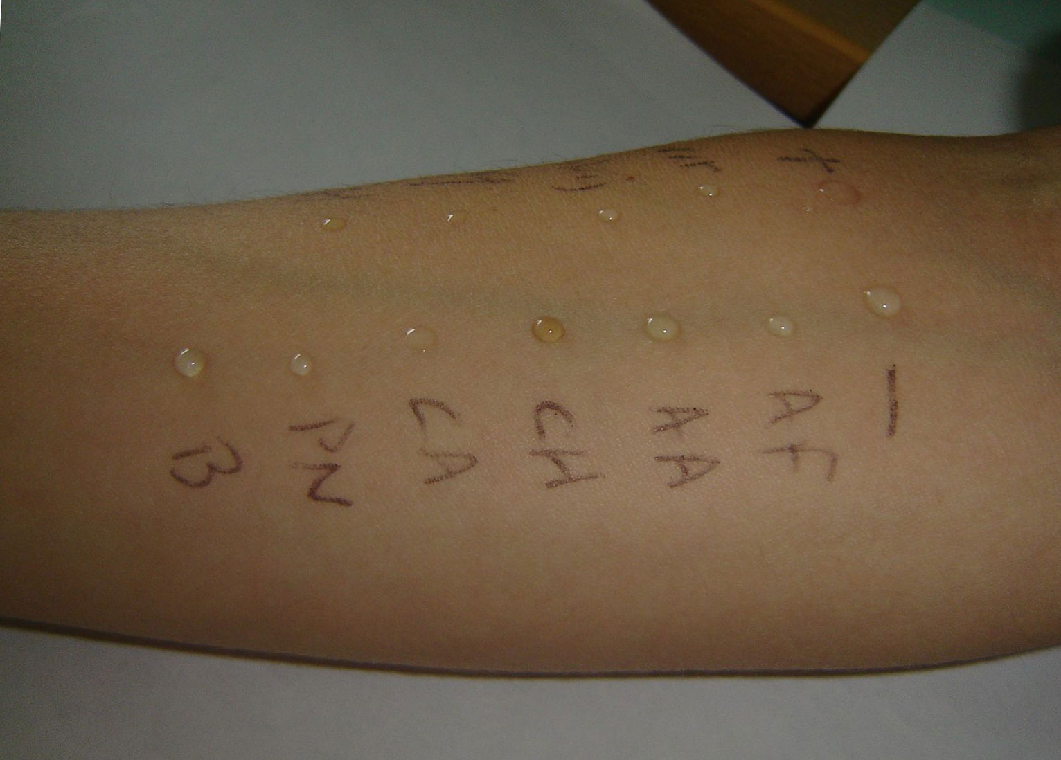 тест на аллергию на руке